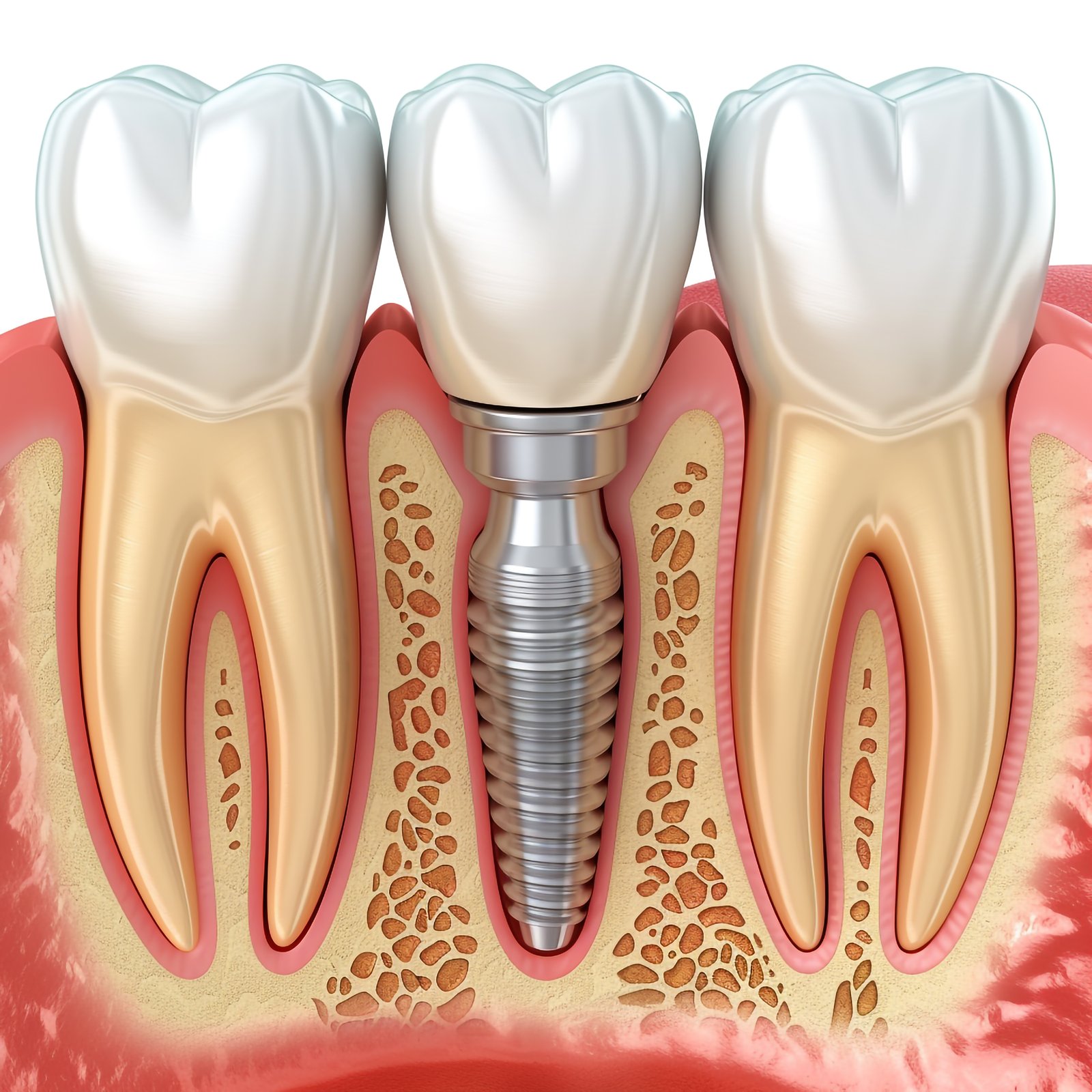Dental Implants