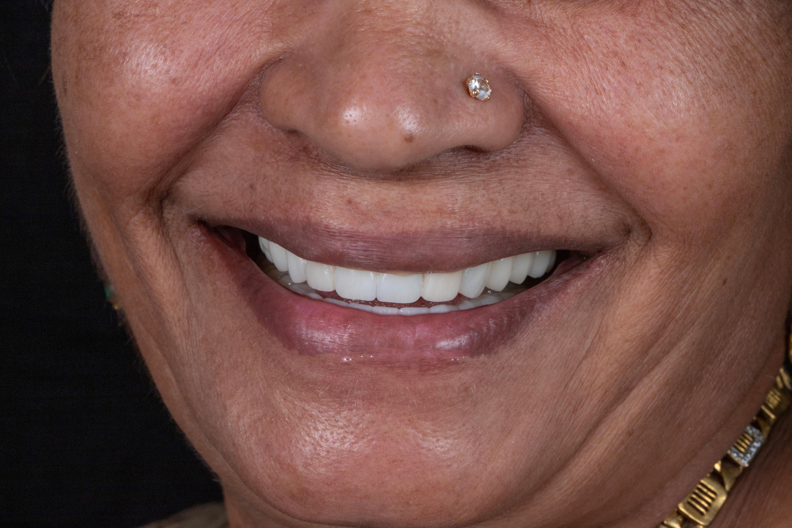 Full Mouth Rehabilitation - Before