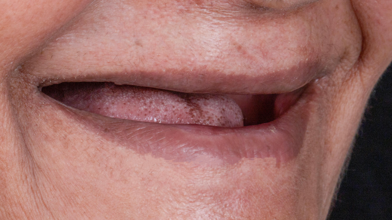 Full Mouth Rehabilitation - After