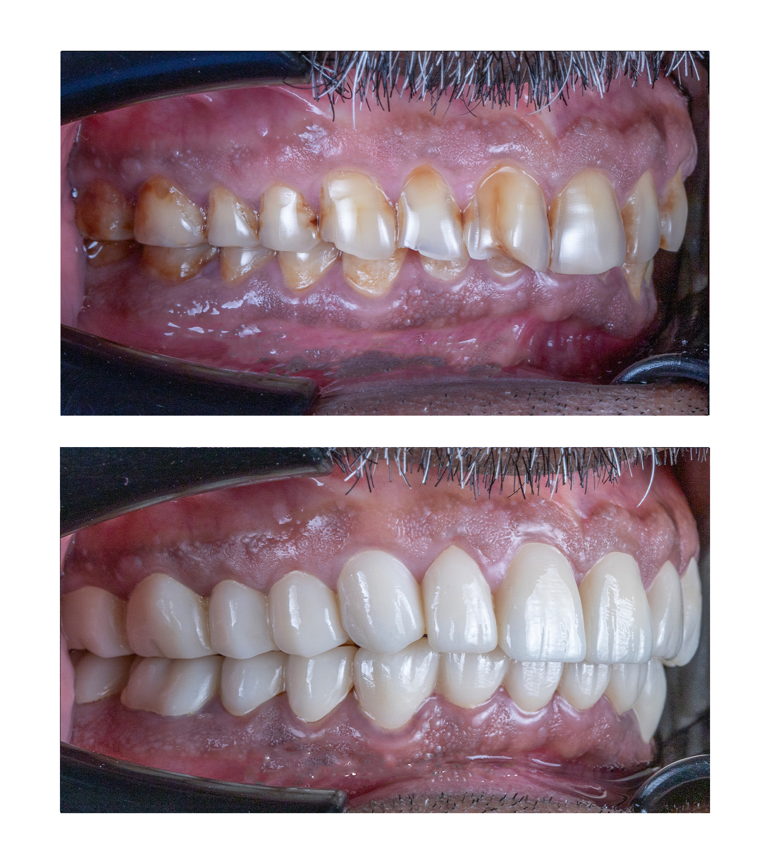 Full Mouth Rehabilitation