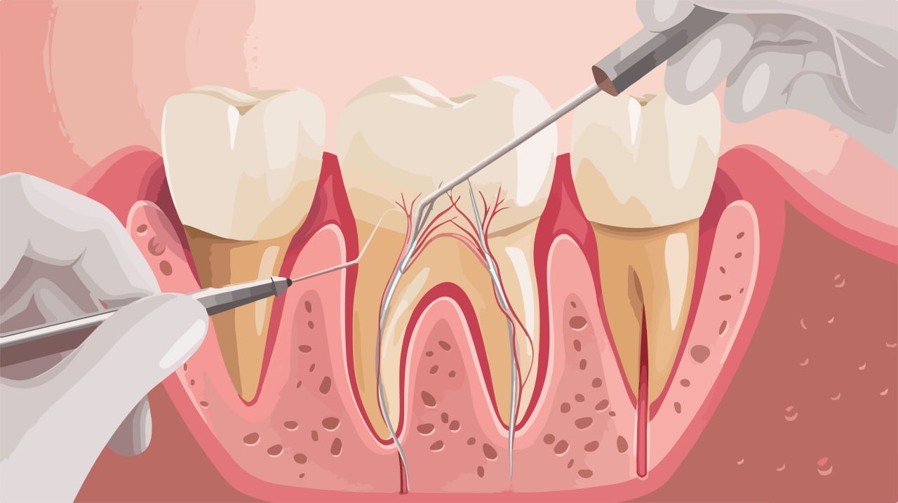 Root Canal Treatment
